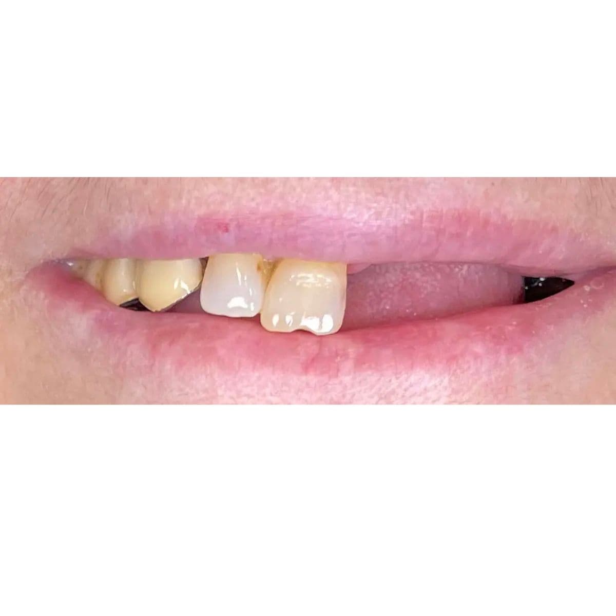 صورة قبل العلاج لحالة تعويض الأسنان المفقودة