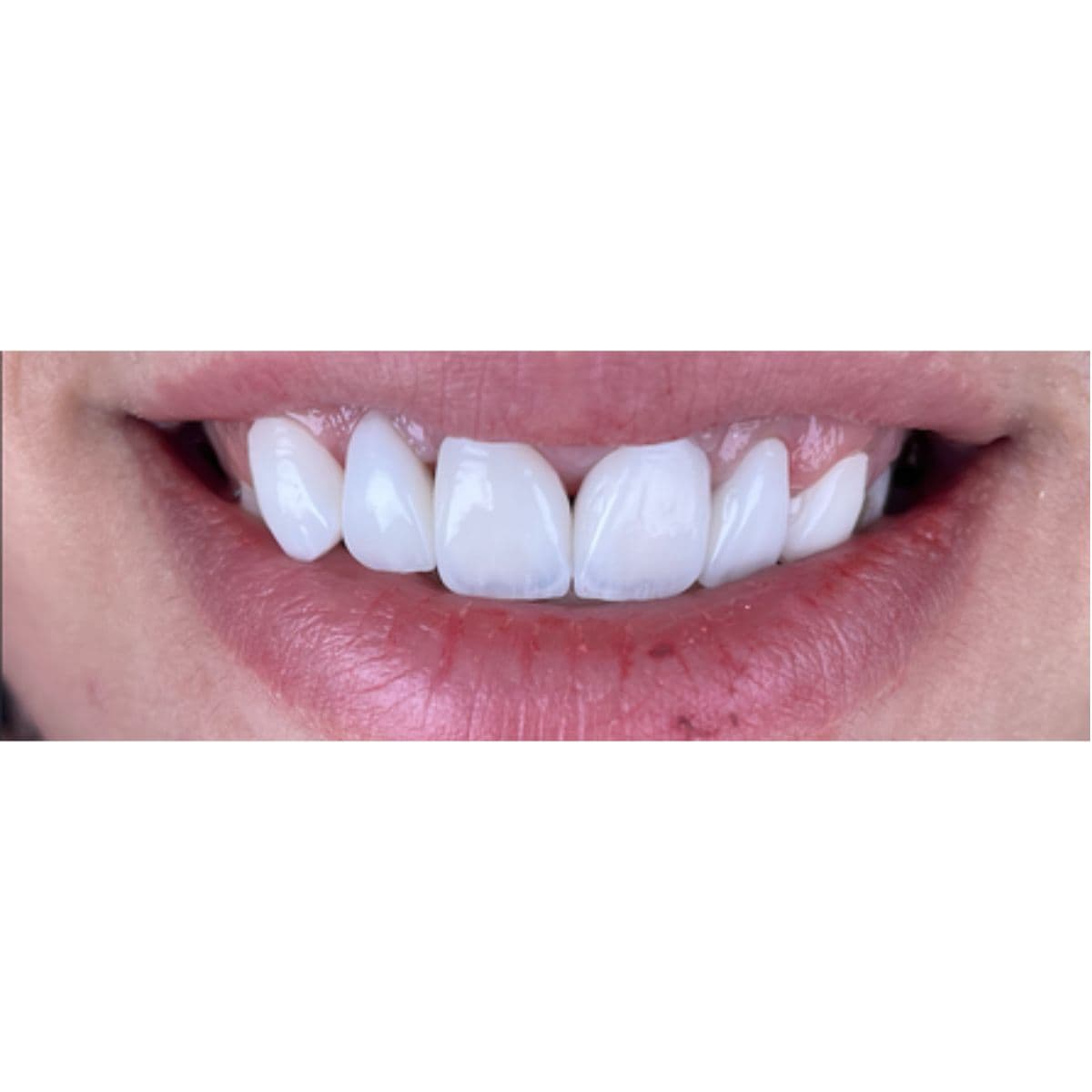 صورة بعد العلاج لحالة تحسين الأسنان الأمامية