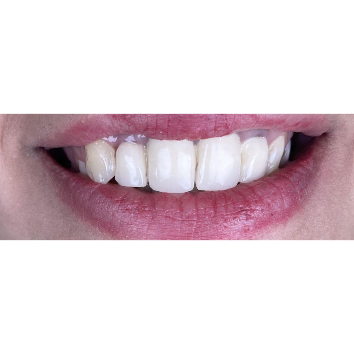 صورة قبل العلاج لحالة تحسين الأسنان الأمامية