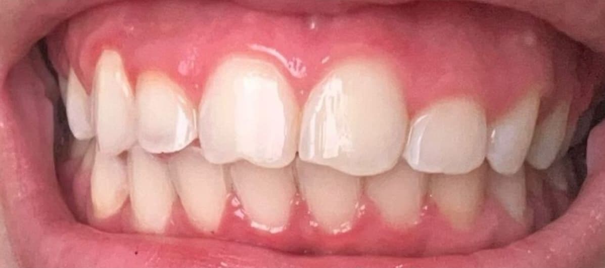 صورة بعد العلاج لحالة تبييض الأسنان