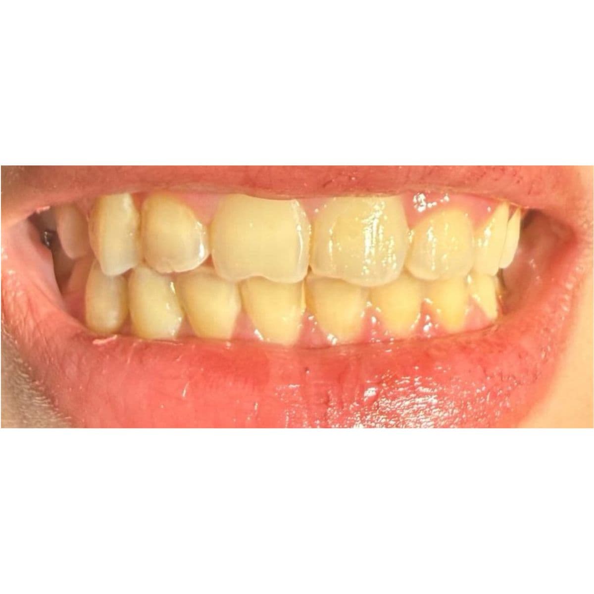 صورة قبل العلاج لحالة تبييض الأسنان